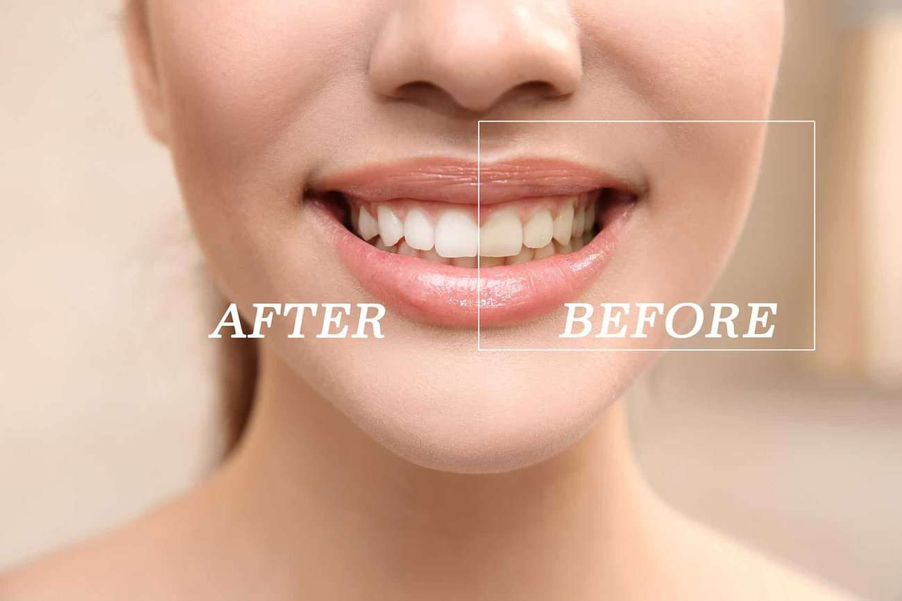 What Are the Most Effective Natural Teeth Whitening Methods You Can Try High-wycombe?