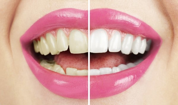 What Makes Ultima White Teeth Whitening Different High-wycombe