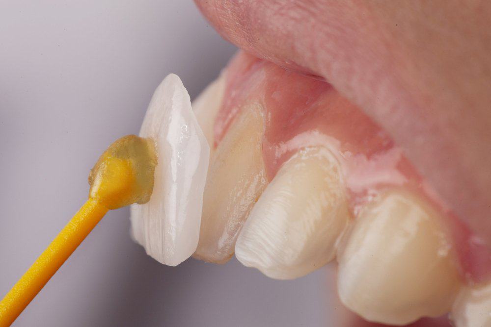 Why Do Dental Crowns Fail or Get Damaged Prematurely High-wycombe?
