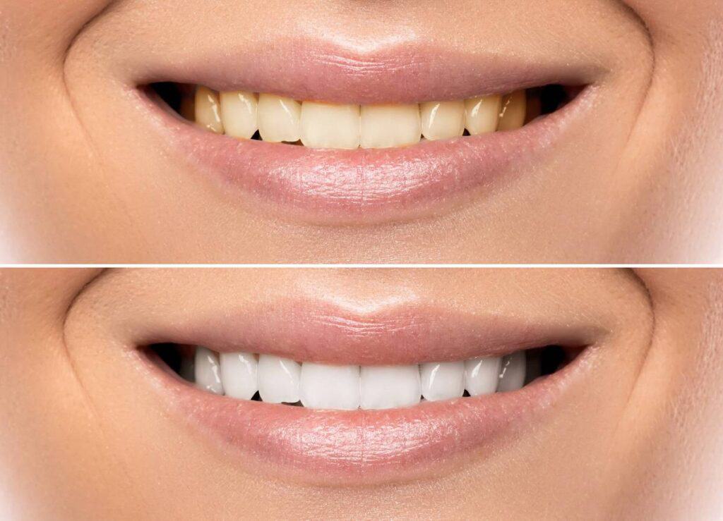 How Does Gum Disease Progress if Left Untreated High-wycombe?