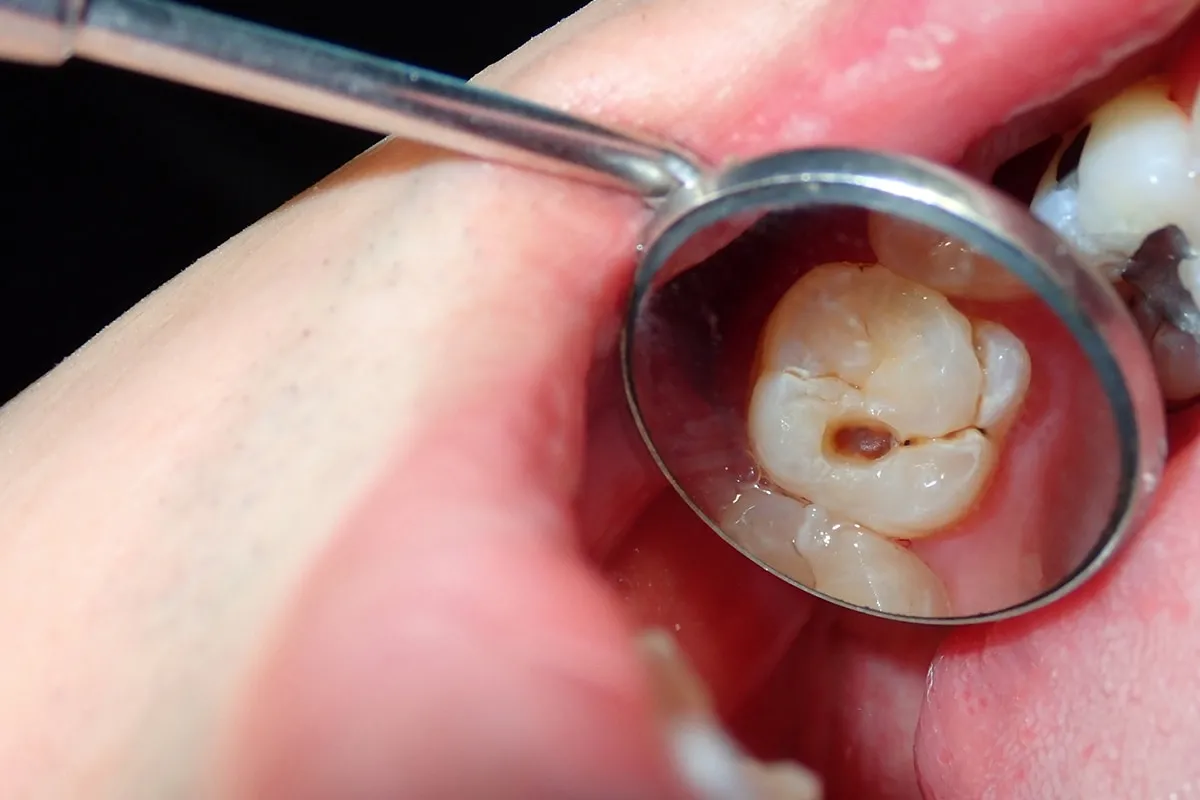 Why Do Teeth Crack? Common Causes to Know High-wycombe