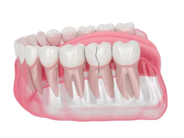How Can You Manage Pain and Discomfort After a Root Canal High-wycombe?