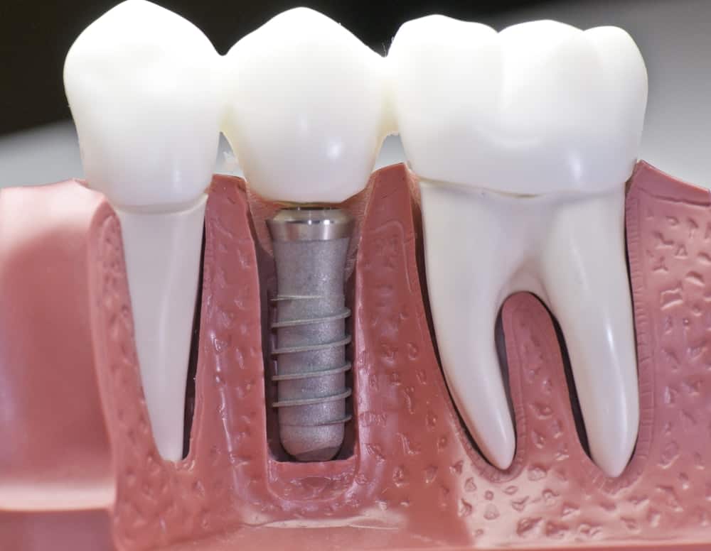 Who Is a Good Candidate for Dental Implants High-wycombe?