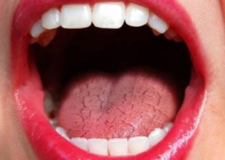Dry Mouth and Its Role in Tooth Decay High-wycombe