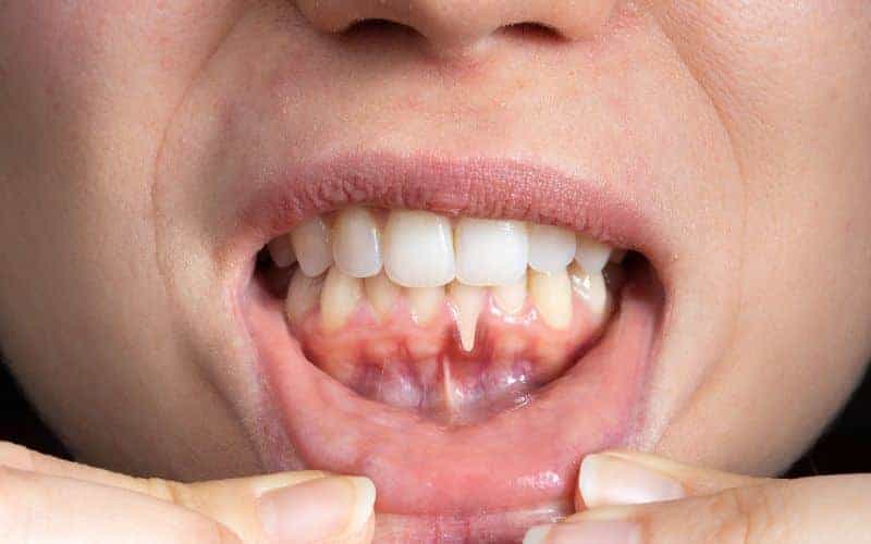 How Can Gum Disease Be Prevented High-wycombe?
