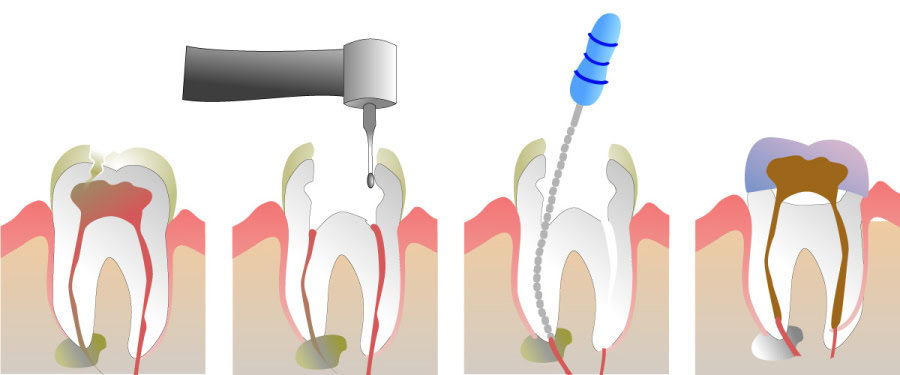 How Do You Properly Care for Your Teeth After a Root Canal High-wycombe