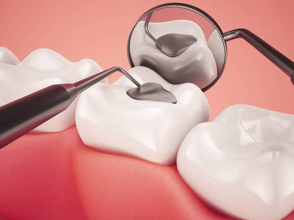 How Can You Prevent Tooth Decay Effectively High-wycombe