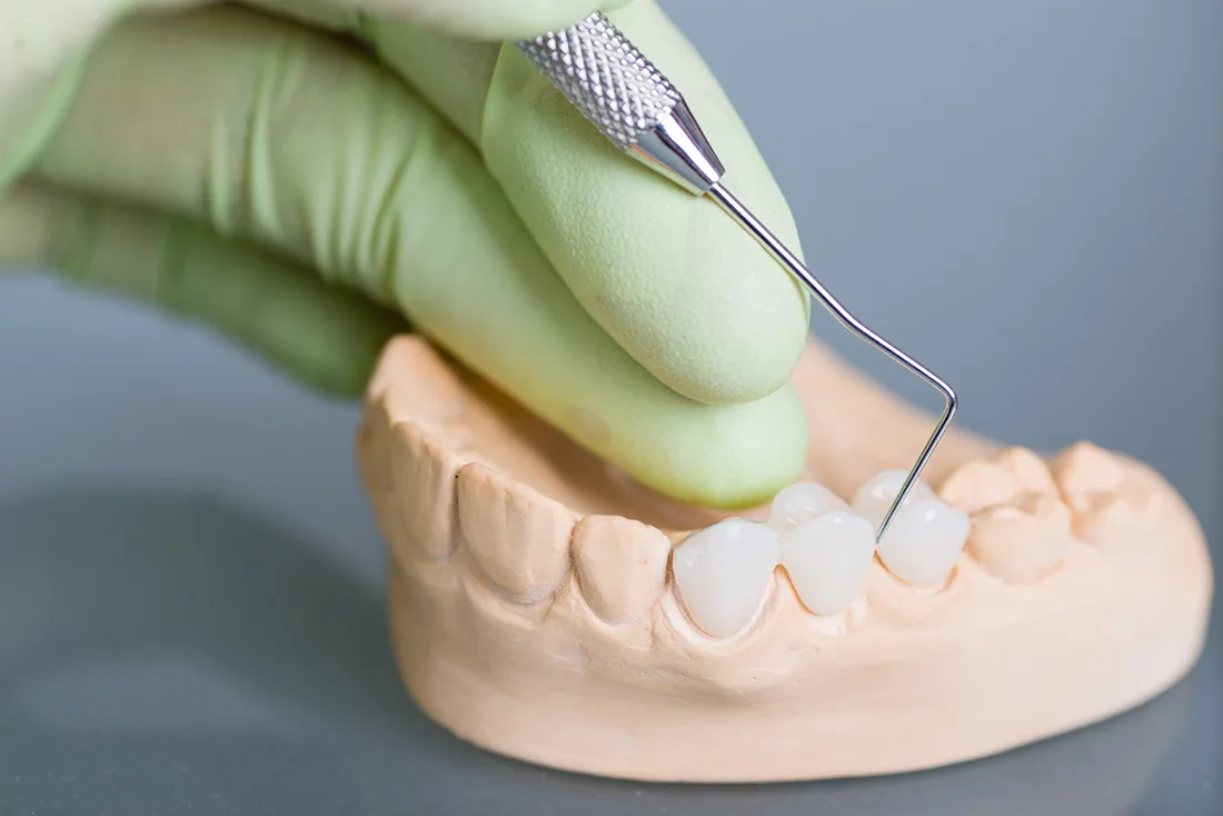 What Are the Different Types of Dental Crowns Available High-wycombe?
