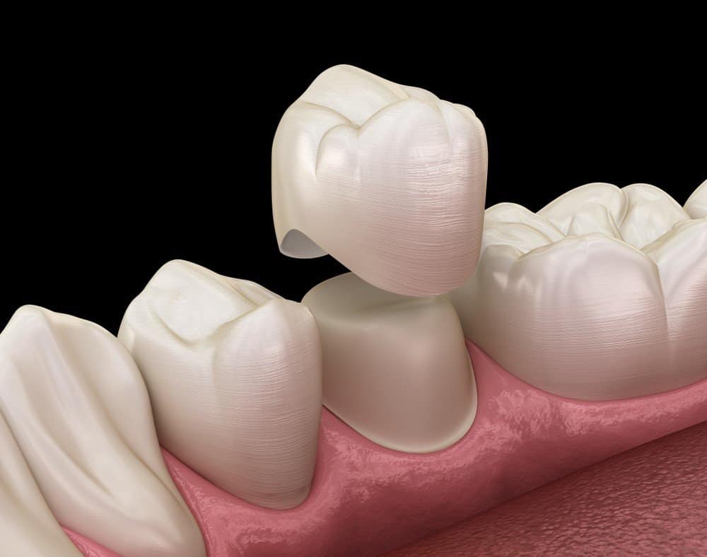 How Can You Prevent Common Dental Crown Problems High-wycombe?