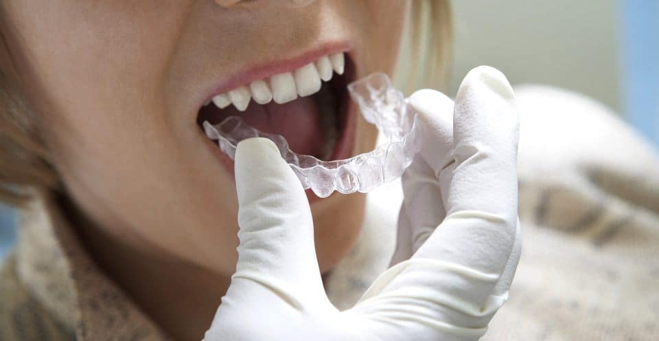 How Much Does Laser Teeth Whitening Cost Compared to Overnight Trays High-wycombe?