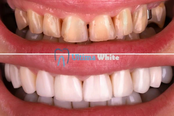 What Makes Instant Teeth Whitening Treatments So Popular High-wycombe?