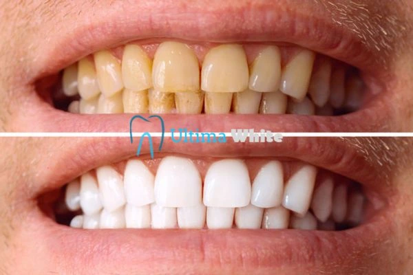 Stained Teeth and Persistent Bad Breath High-wycombe
